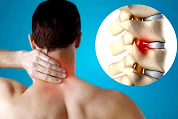 Cervical Spondylosis