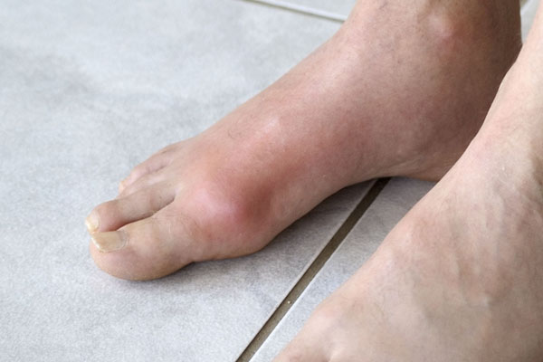 Gout