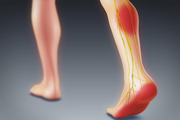 Sciatica